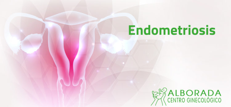 Endometriosis: origen, síntomas y tratamiento